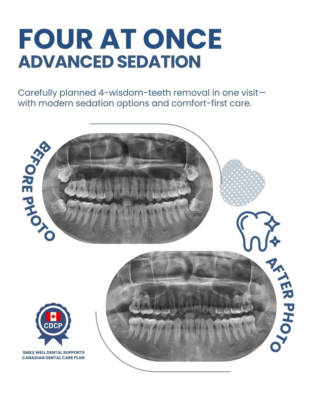 Sedation Dentistry in Coquitlam